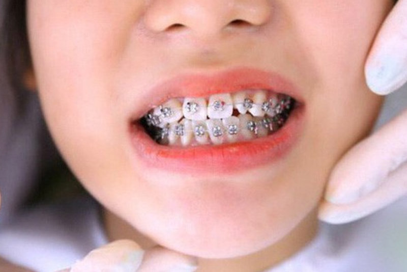 Phòng khám nha khoa niềng răng ở đâu tốt TPHCM cho trẻ? - NKTĐ