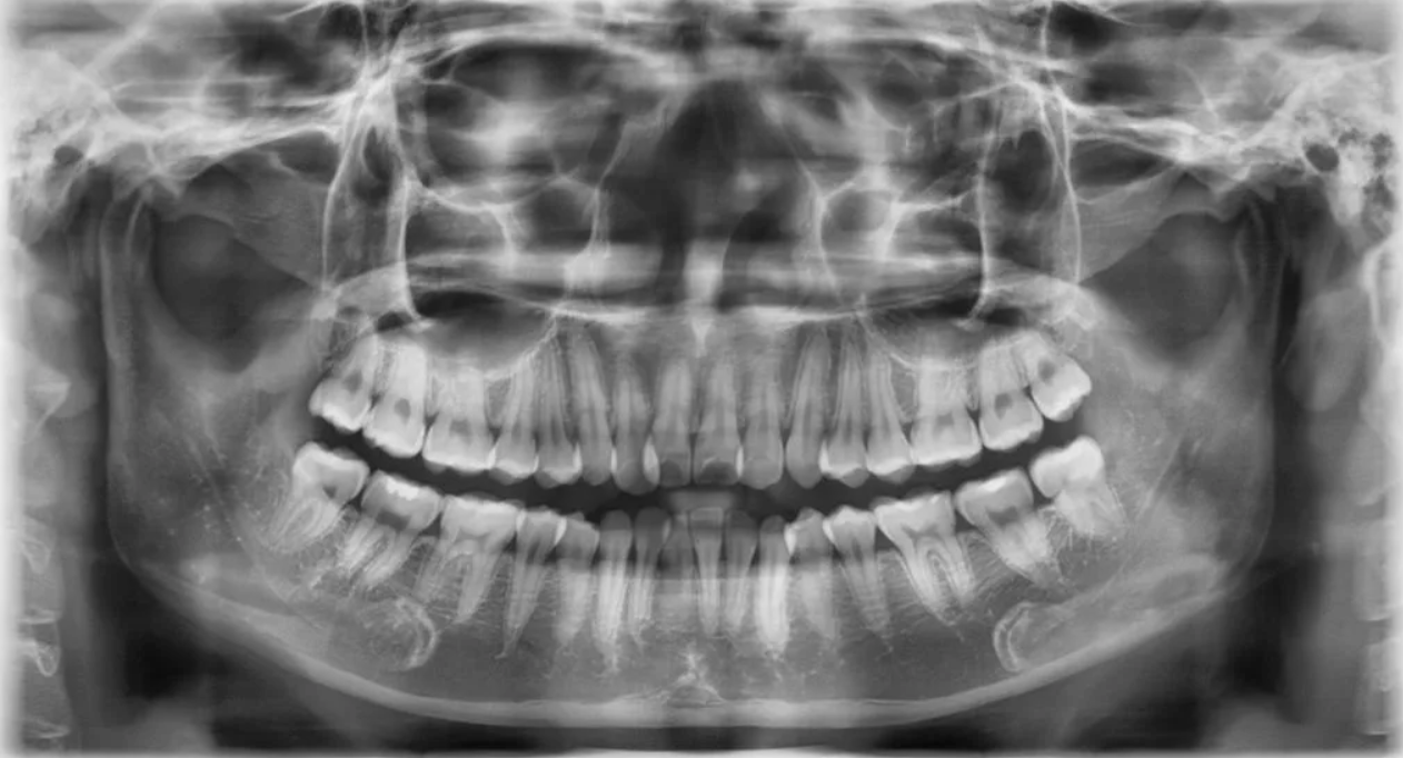Chụp X quang răng cận chóp: Khi nào cần thực hiện? | Vinmec