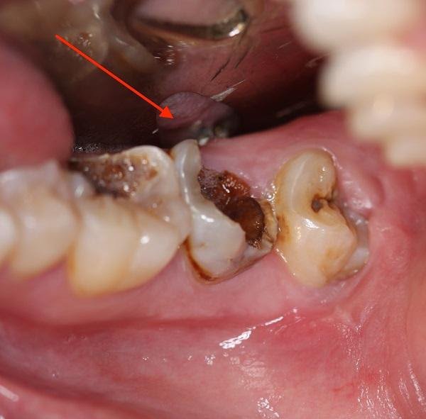 Nguyên tắc điều trị răng hàm sâu bị vỡ chỉ còn chân răng | Vinmec