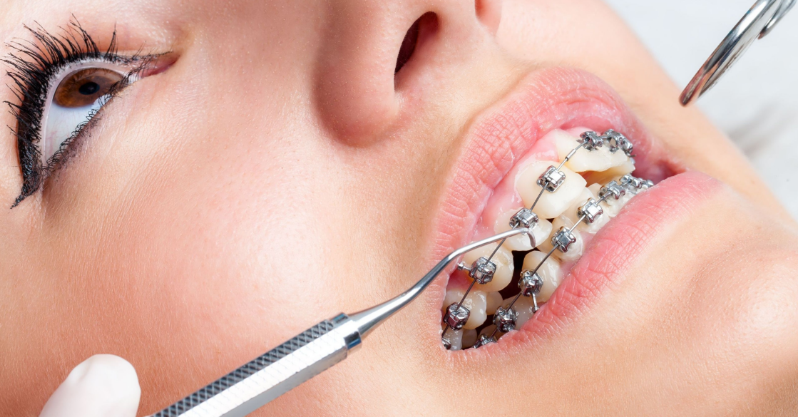 Những ưu điểm của phương pháp niềng răng mắc cài kim loại truyền thống